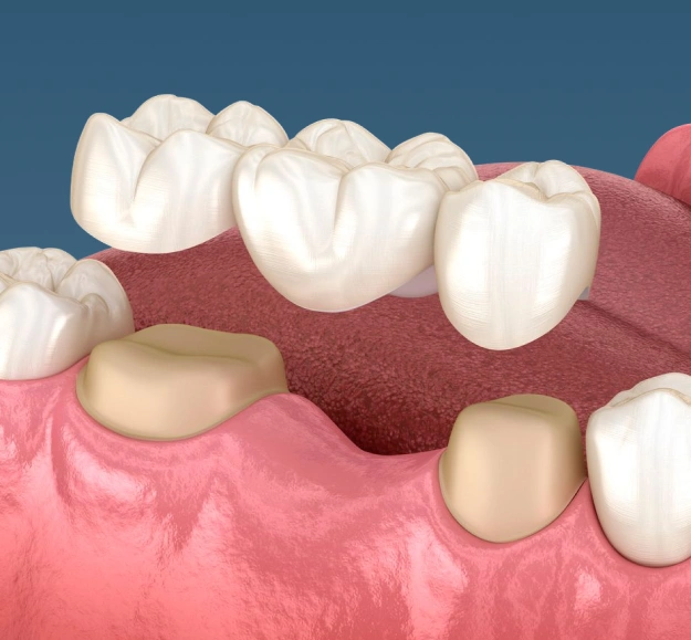 Dental bridge replacing missing teeth between natural teeth